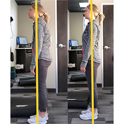 Chiropractic Appleton WI Callie Huft Posture Before And After